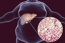 Leia mais sobre o artigo Doença Hepática Gordurosa Não Alcoólica e Doença Cardiovascular: Entendendo a Conexão Através da Alimentação e Resistência à Insulina